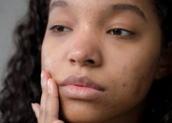 4 Tips on How to Treat Adult Acne